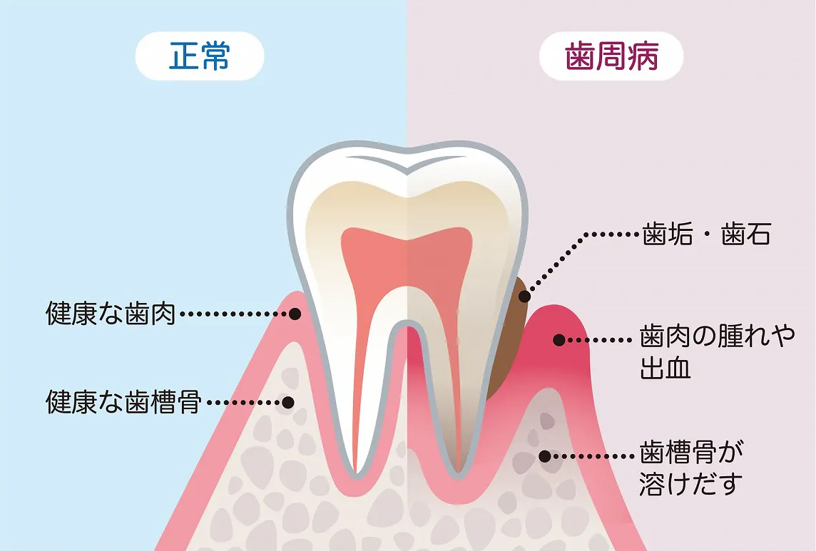 正常な歯茎と歯周病の歯茎の比較