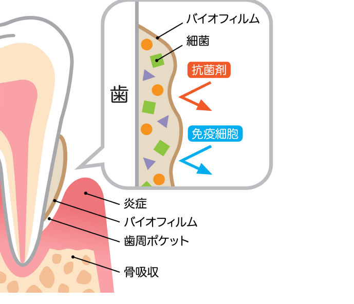 歯垢と歯周病の仕組み