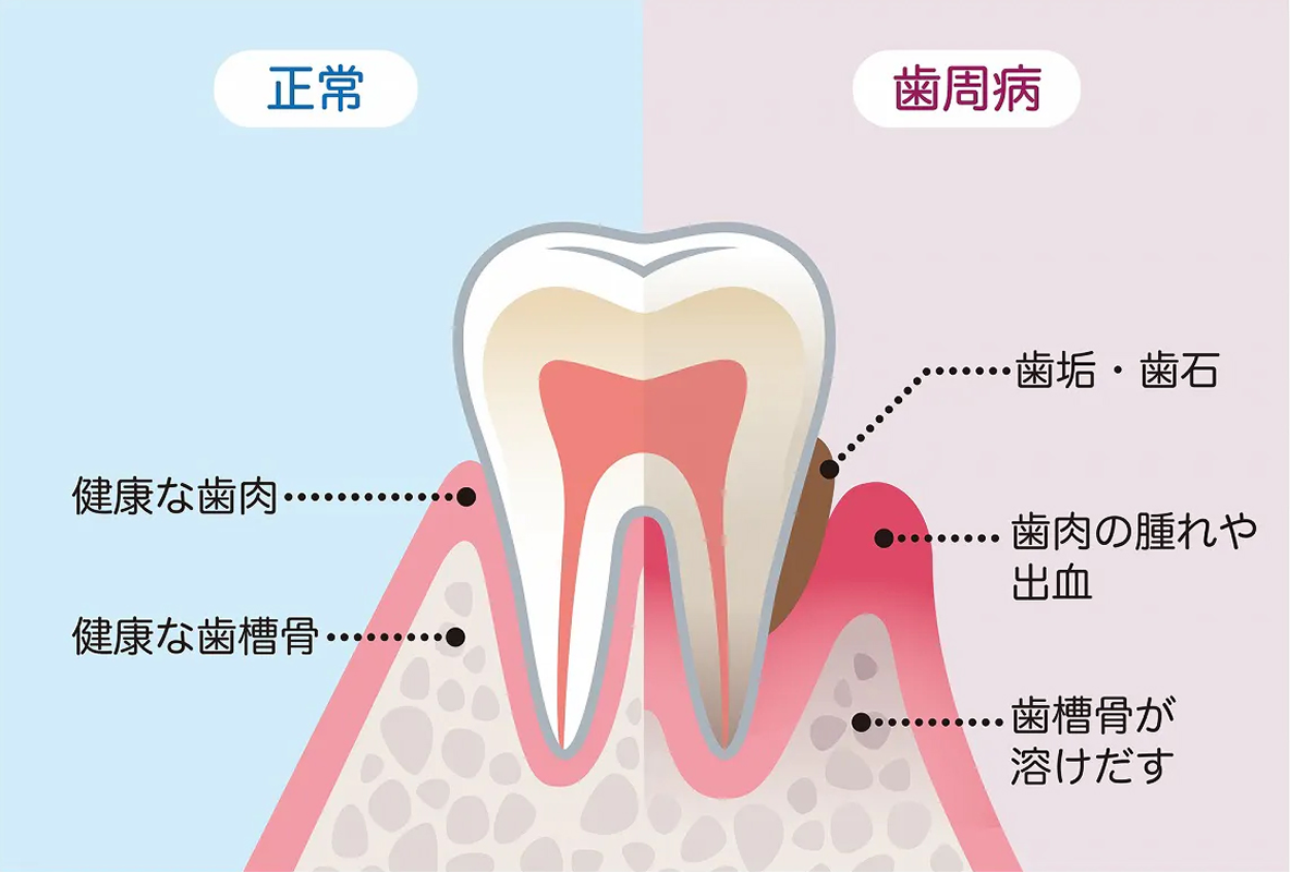 正常な歯茎と歯周病の歯茎の比較